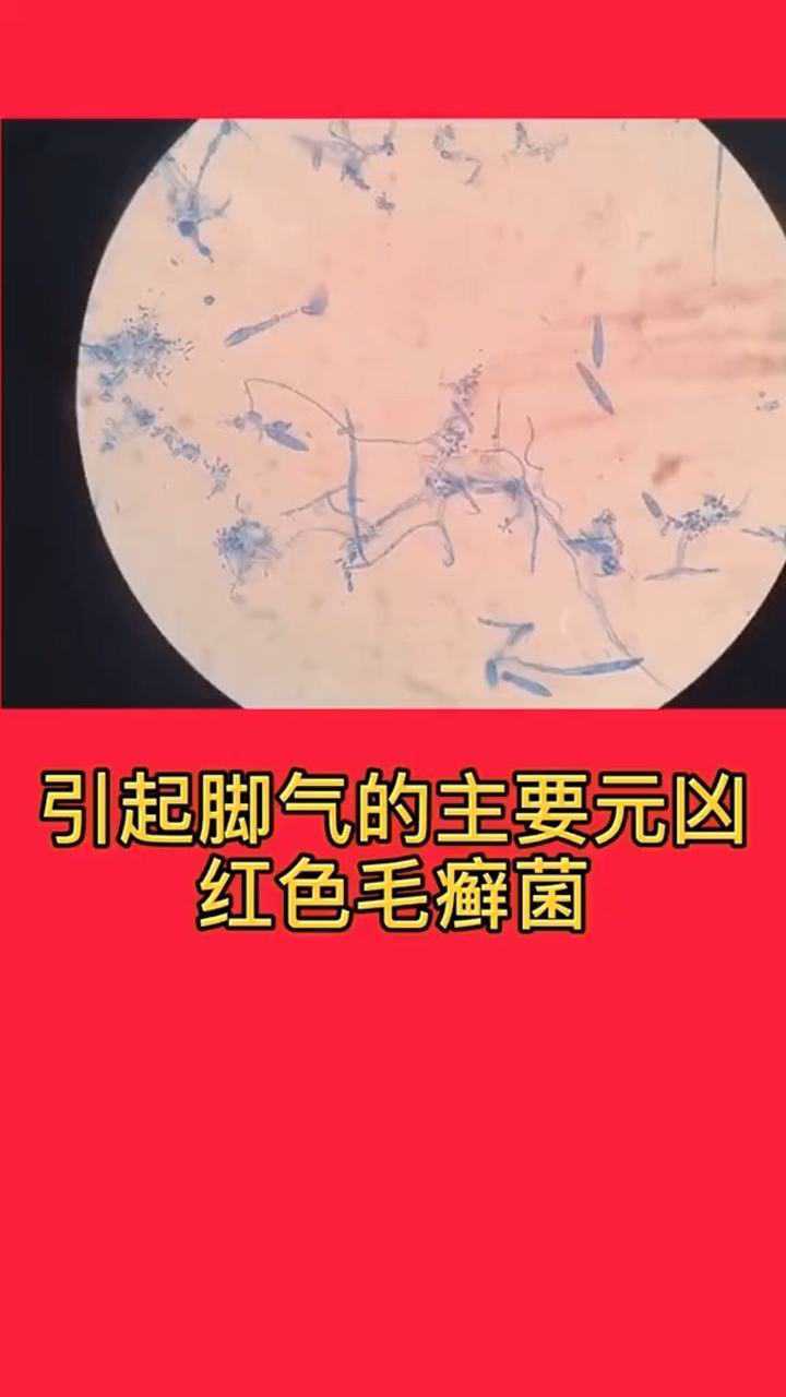 揭秘,引起脚气的元凶之一红色毛癣菌,太恐怖!