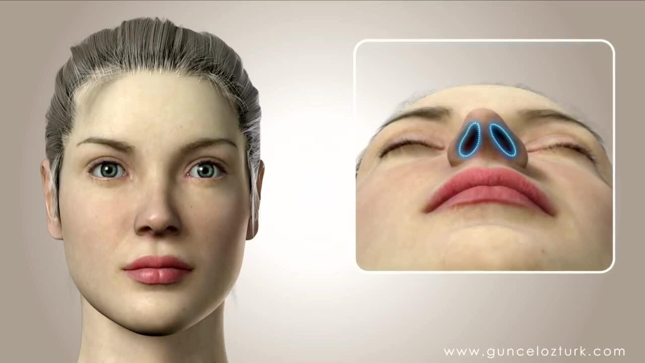 动画演示: 隆鼻术rhinoplasty (nose job