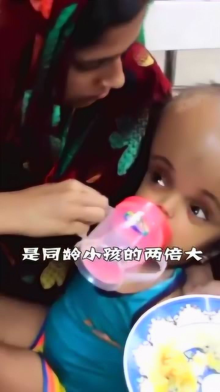 世界上最大头的婴儿出生在印度被誉为神明