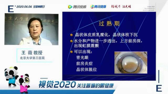 白内障疾病科普——王薇教授 北京大学第三医院