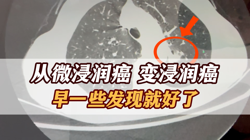 可惜,从微浸润癌拖成"浸润癌"!有时固执真不是一件好事