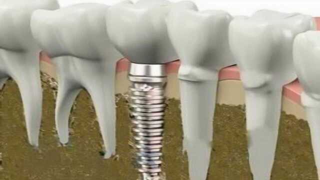 种植牙是怎么种的?3D动画演示全过程,答案跟你想的真的不一样!