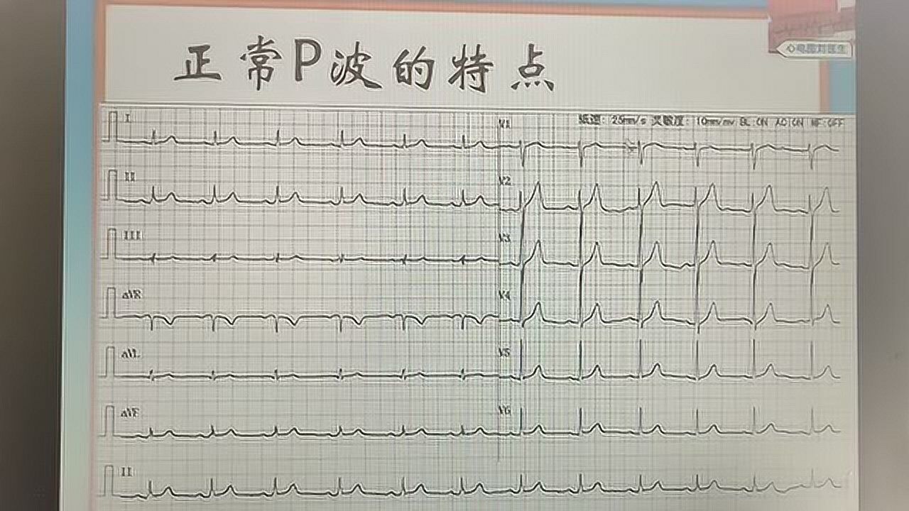 心电图基础学习:认识p波,正常p波的特点