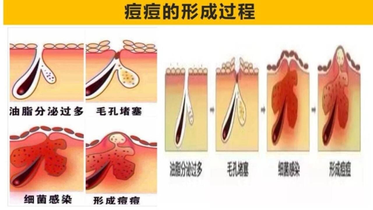 痘痘是怎么回事?与皮肤的这个结构有关系,了解一下详细知识吧_腾讯视频