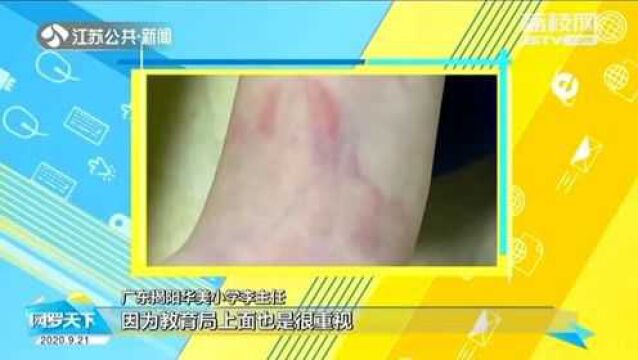 小学生没写作业遭老师鞭打手掌淤血 家长反映却被移出群聊!