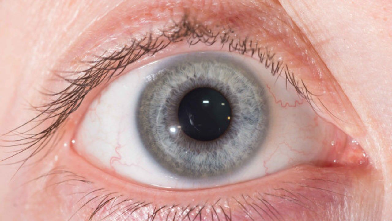眼珠子有黄斑红血丝是怎么回事要排除这3种原因