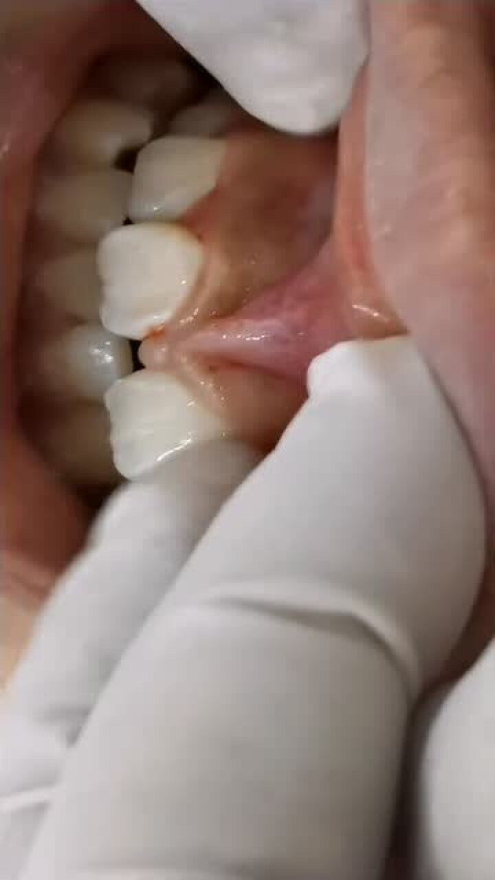 孩子门牙有缝,你需要关注孩子的唇系带!