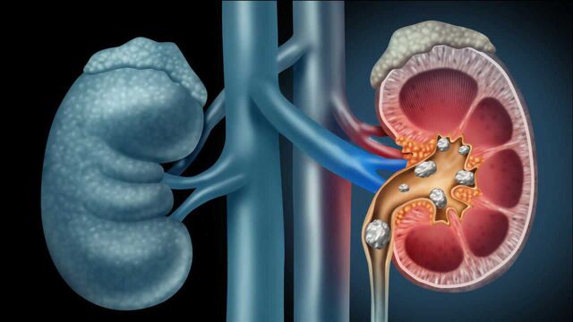 肾结石早期不疼不痒,身体出现2个求救“信号”,警惕结石已上门