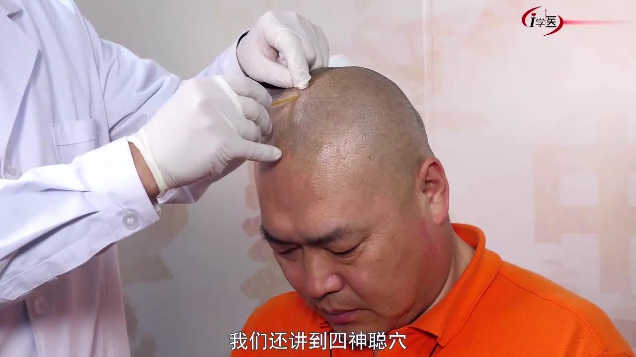 王合民教学 百会四神聪穴 放血