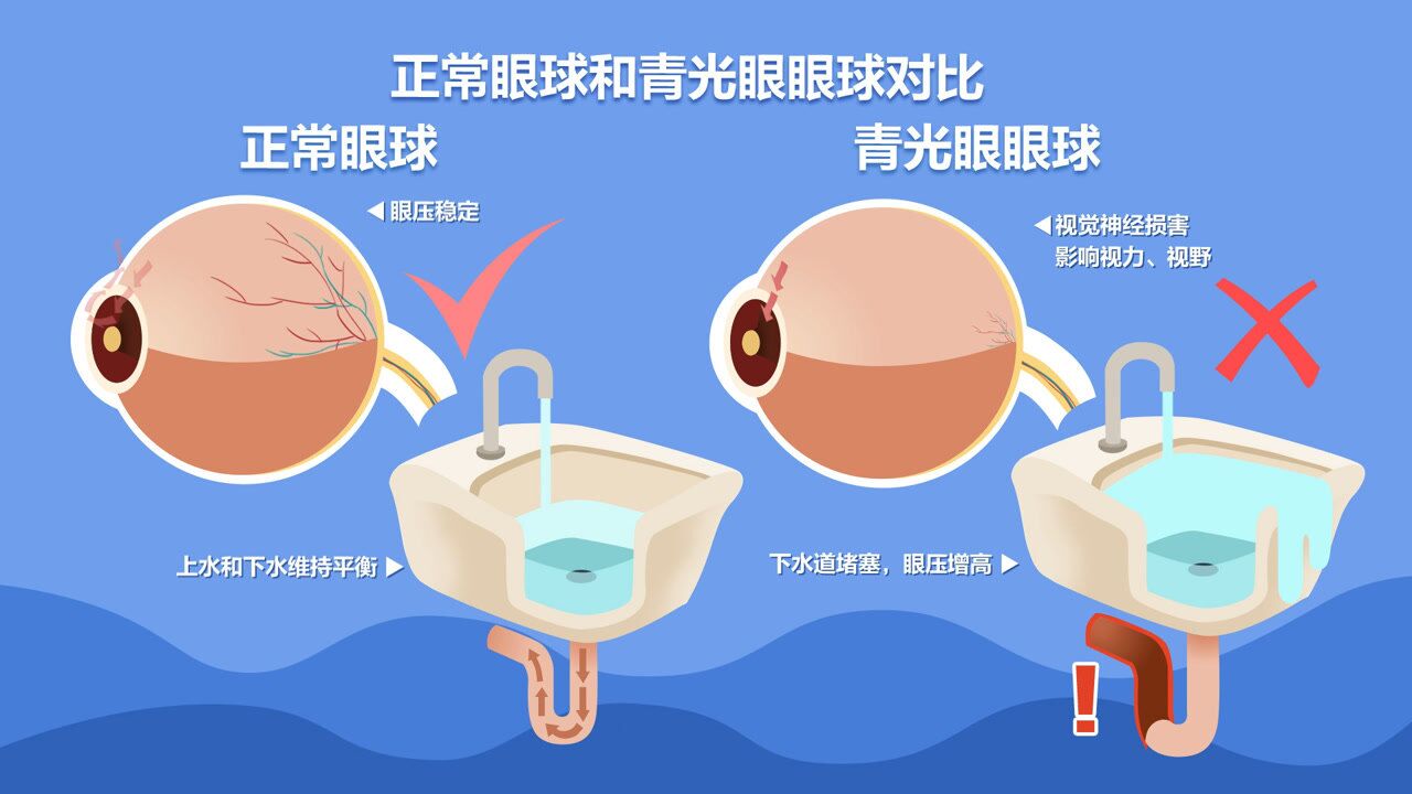 不开刀并发症少 长沙爱尔眼科引进青光眼治疗新技术ucp