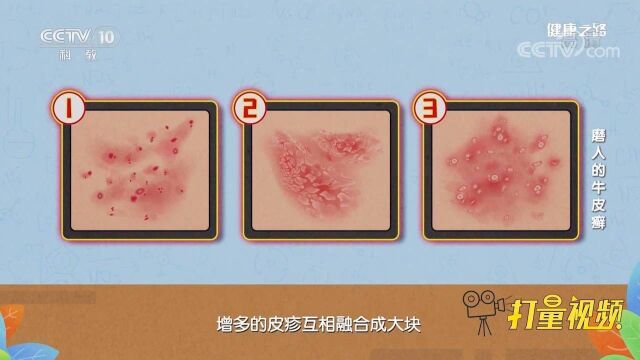 身体出现小皮疹?有这些特点的警惕,可能是牛皮癣