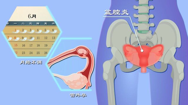 月经不调?怀孕困难?还会搞出宫外孕?盆腔炎危害有多大?硬核科普