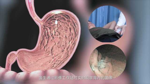 告别“畏”镜 胶囊内镜“侦察兵”在巴中康达医院上线