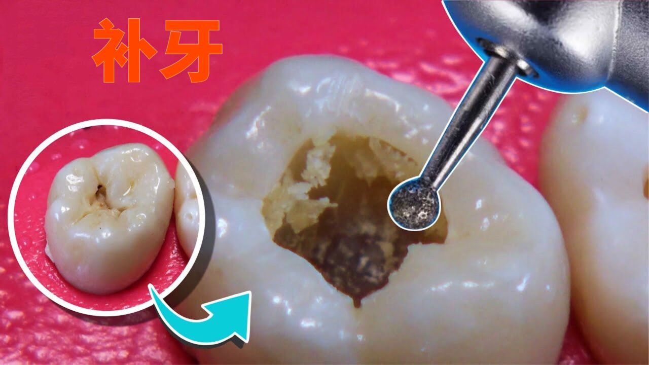 长期吃糖导致牙齿龋齿,清理蛀牙,修补一下牙齿