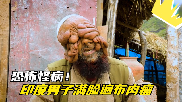 恐怖怪病!印度男子满脸遍布肉瘤,全身上下无一幸免