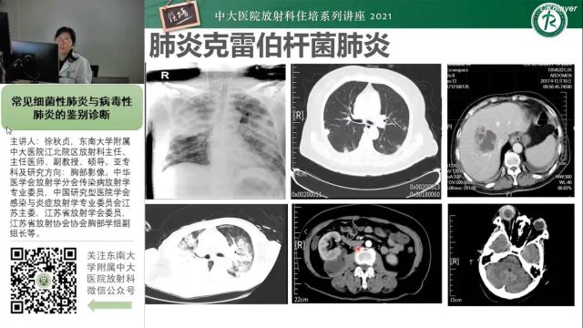 常见细菌性肺炎与病毒性肺炎的鉴别诊断中大徐秋贞