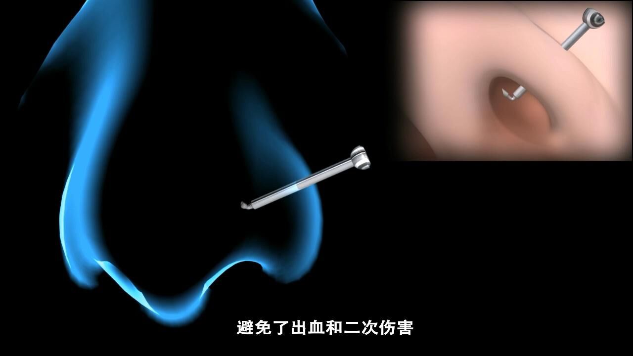 弗司美特弯头鼻钉操作视频_高清1080P在线观看平台_腾讯视频