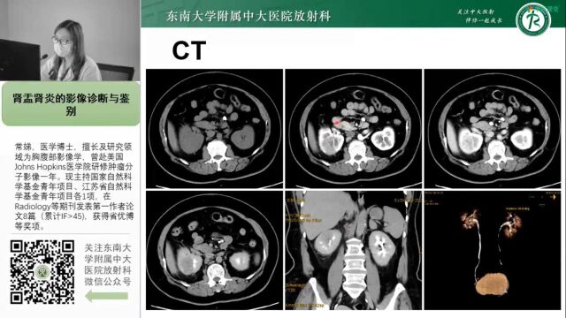 肾盂肾炎的影像诊断与鉴别中大常娣