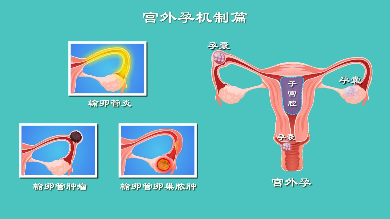 受精卵緣何子宮外安家?是輸卵管不通?還是炎症,腫瘤在作妖?