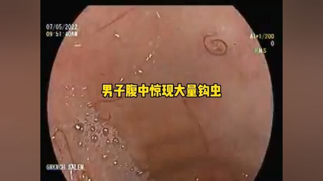 男子腹中惊现大量钩虫#寄生虫 #寄生虫的危害