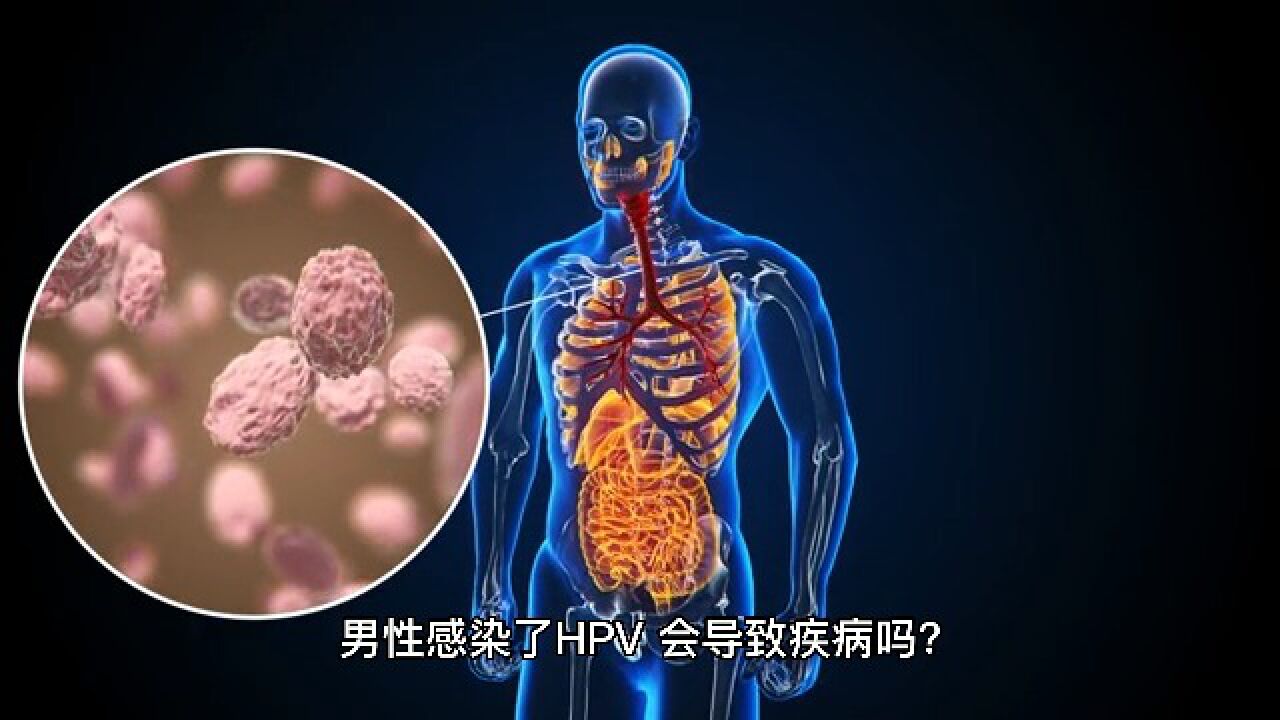 男性感染了hpv会导致疾病吗 南京华肤医院