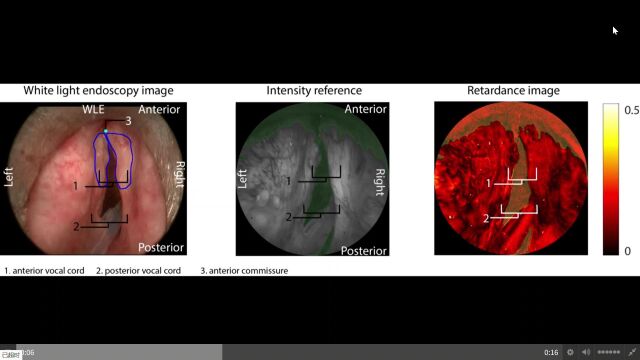 Surgical polarimetric endoscopy for the detection of laryngeal cancer