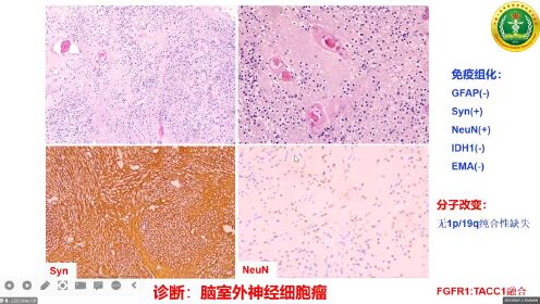 王蔚主任--中枢神经系统具有少突胶质细胞样形态肿瘤归纳及诊断-1