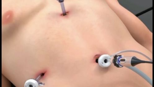 3D视频演示：腹腔镜胆囊切除术