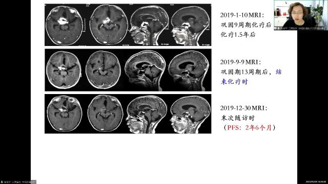 先声特约 | 专访三博脑科医院张俊平:儿童型低级别胶质瘤预后好 化疗敏感度高 但应尽量推迟放疗