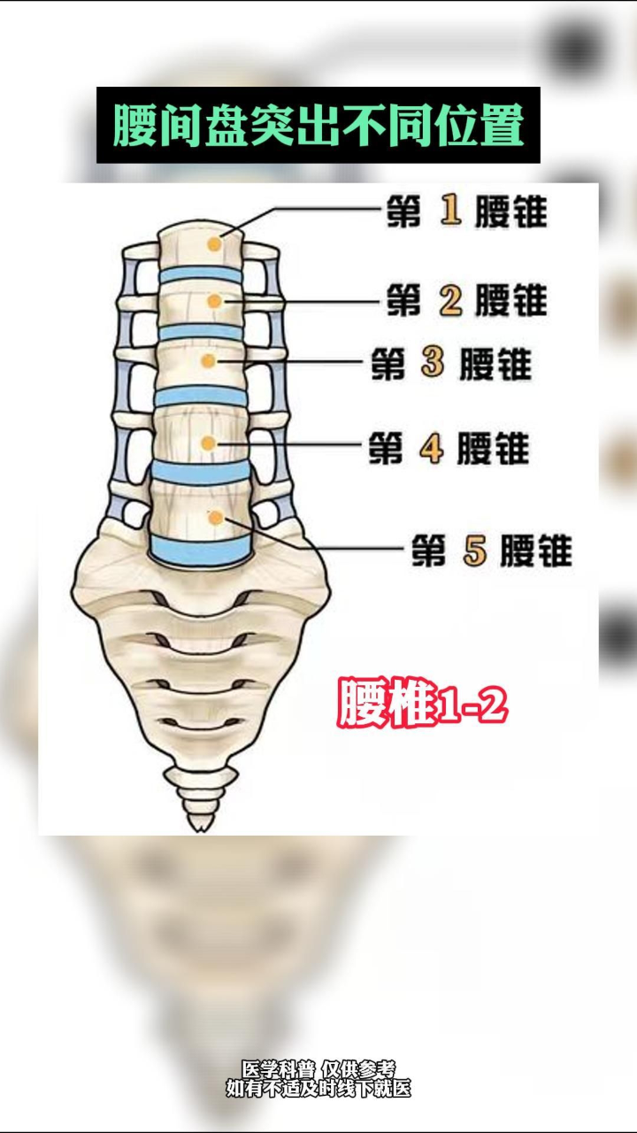 腰间盘突出不同位置