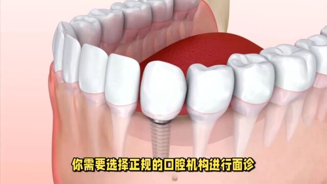 种植牙需要满足哪些条件?