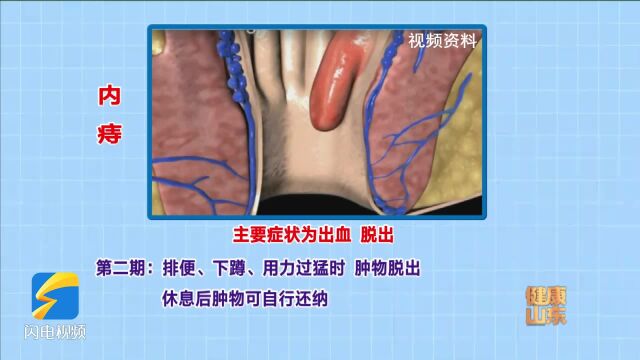 十人九痔 如何知道自己是不是得了痔疮?