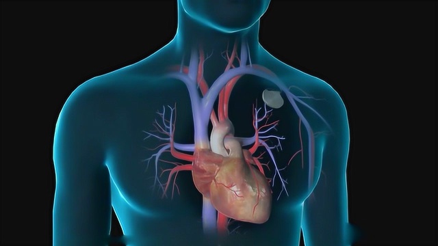 3d动画演示植入心脏起搏器手术过程看的我这小心脏嘭嘭跳