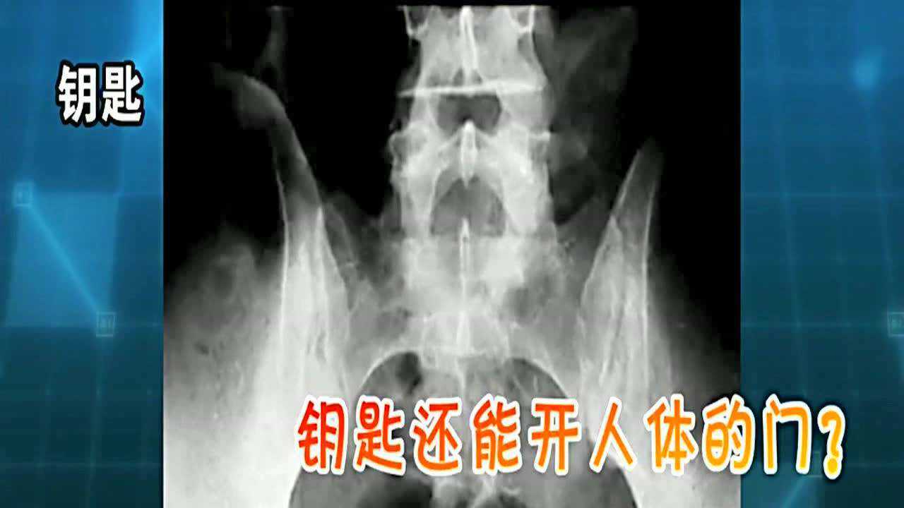 盘点体内那些奇葩异物的X光片_高清1080P在线观看平台_腾讯视频