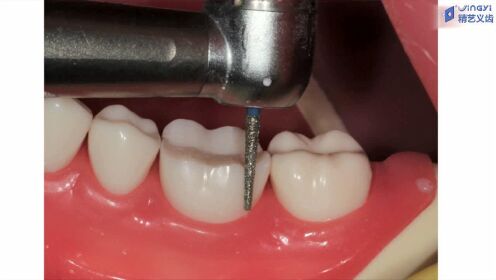 磨牙(后牙)牙体预备