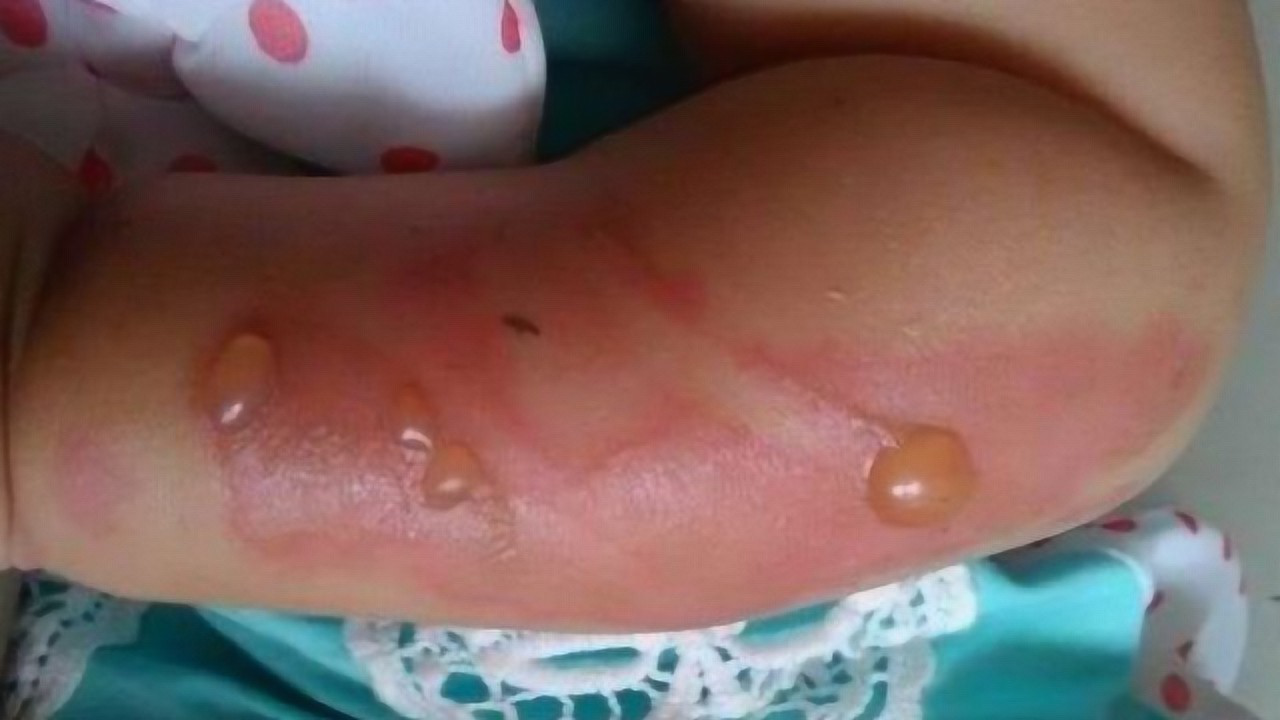3岁宝宝被热水烫伤，婆婆用这东西给孩子抹完后，孩子竟休克脱皮！