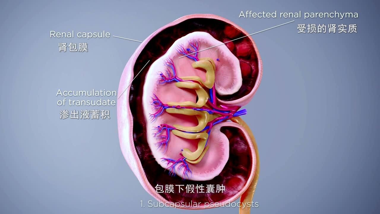 13腎周假性囊腫