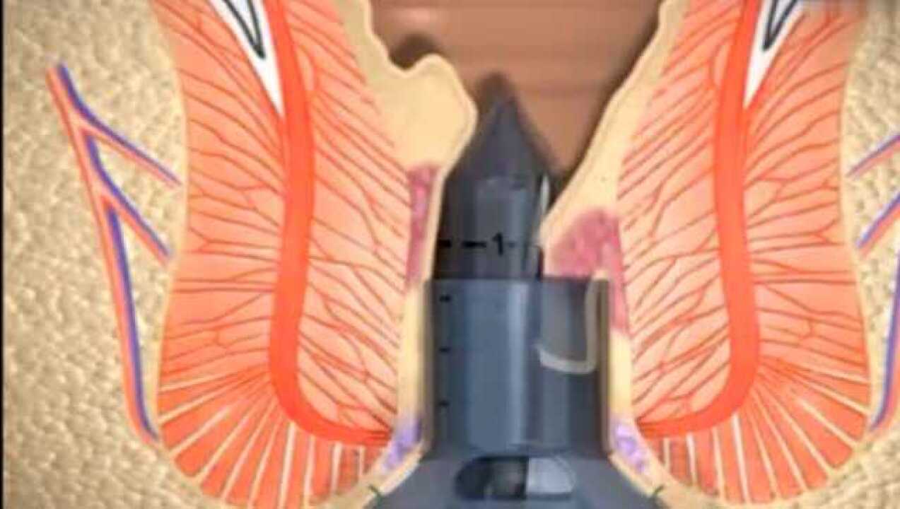 原来割痔疮手术是这样的_腾讯视频