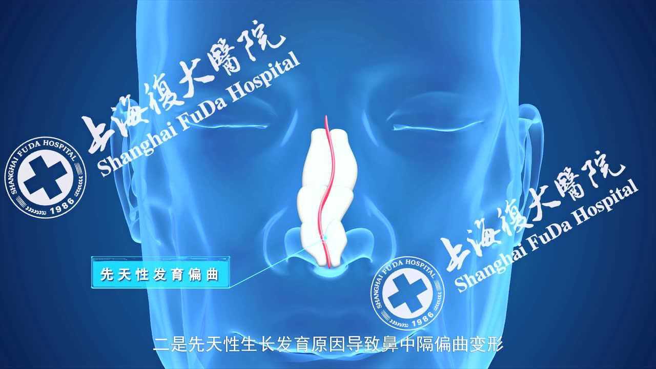 鼻中隔偏曲的治疗过程_高清1080P在线观看平台_腾讯视频