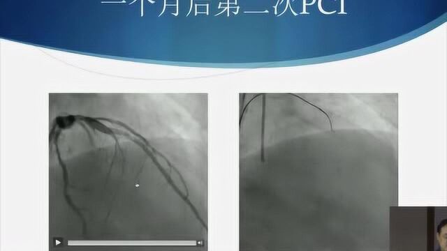 华医心诚专家讲堂:武警总医院韩玮教授“一波三折:从ATO到CTO”