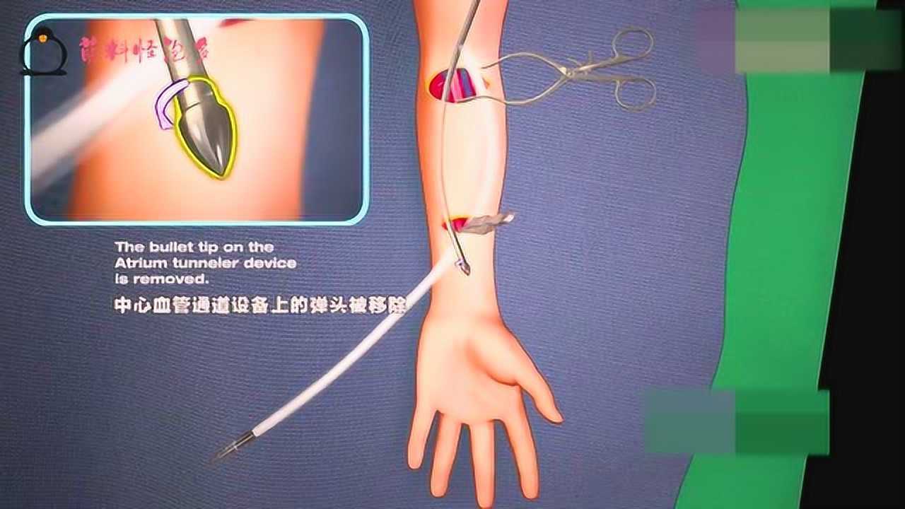 什么是血液透析？透析的过程是怎样的？3D动画演示透析操作过程！_高清