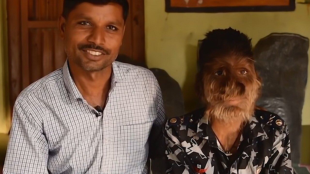 印度男孩患有狼人综合症出生时全身长毛医生都束手无策