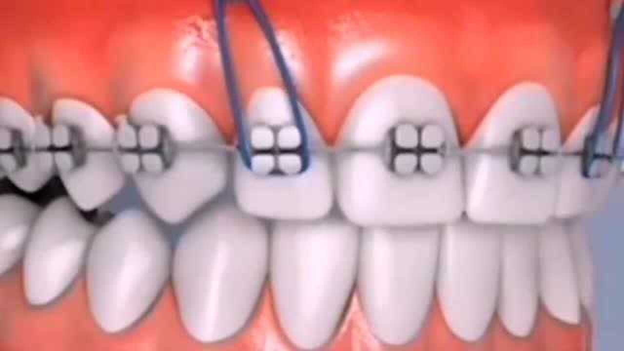 牙齿天包地也很难看,3D演示整牙全过程,要在换牙时期就开始整牙!_腾讯视频