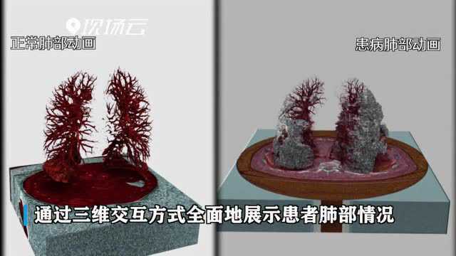 北大医学视觉技术新突破:彩色3D影像直观呈现肺炎病变