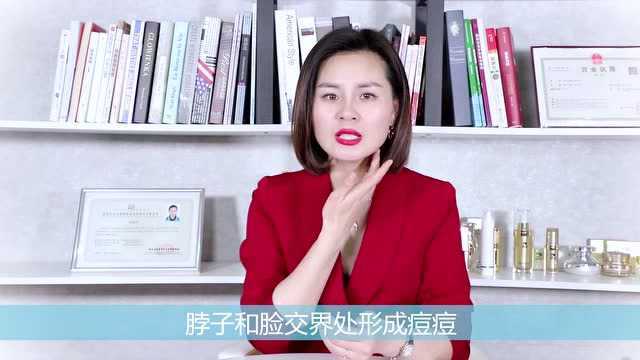 脖子上长痘是什么原因,为什么脖子两侧长痘痘,怎么处理?