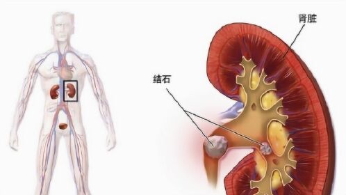 肾结石是怎样取出的?3d动画还原全过程,看完之后胸口疼!