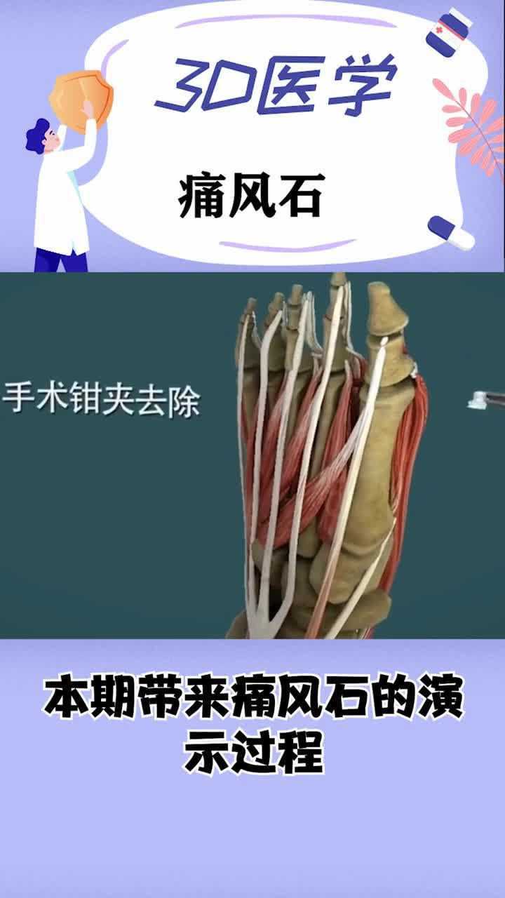 痛风石的手术过程指甲就这样被拔了