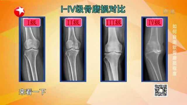 名医话养生:膝盖软骨磨损有什么后果?专家:它是软骨退变的产物