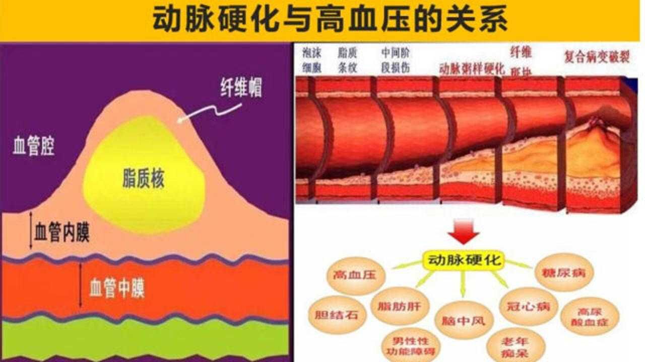 高血压是怎么来的?与动脉粥样硬化有一定关系,了解一下详情吧_高清1080P在线观看平台_腾讯视频
