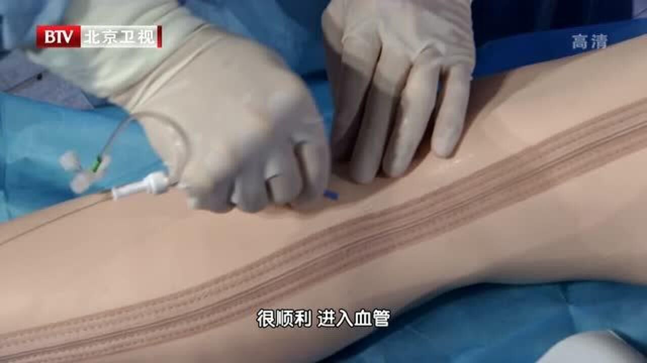 射频消融术，微创解决静脉曲张新技术，专家现场演示手术过程！_高清